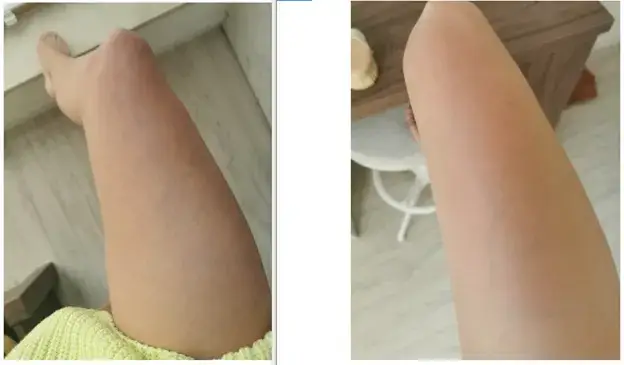 szczotkowanie na sucho bańka chińska efekty