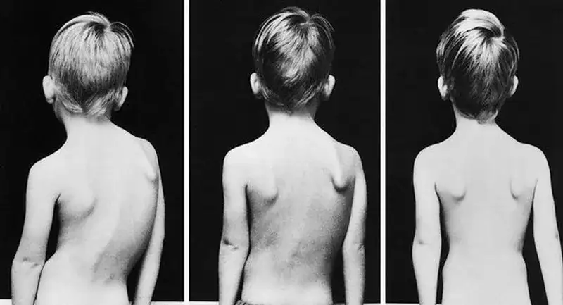 dziecko wady postawy skolioza