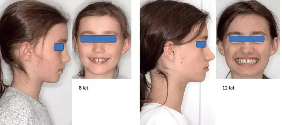 leczenie ortodontyczne dorośli vs dzieci efekty twarzy