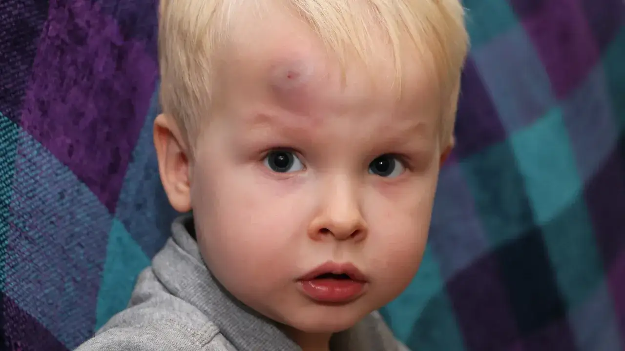 dziecko z guzem na głowie płaczące