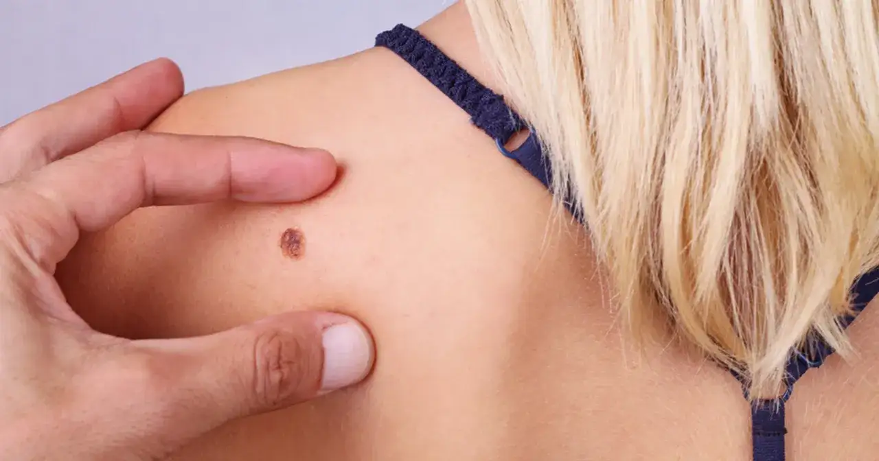 Dłoń wskazuje na pieprzyk na ramieniu, który może przypominać jak wygląda czerniak: nieregularny kształt i ciemne zabarwienie.