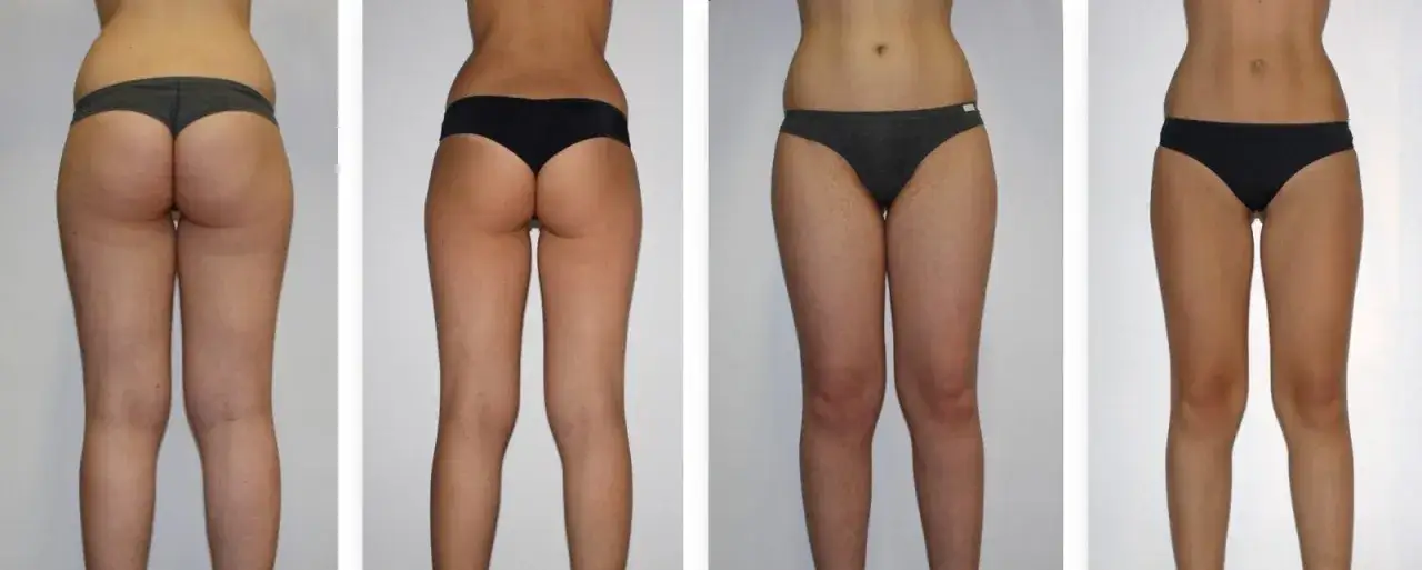 Endermologia LPG Alliance przed i po efekty