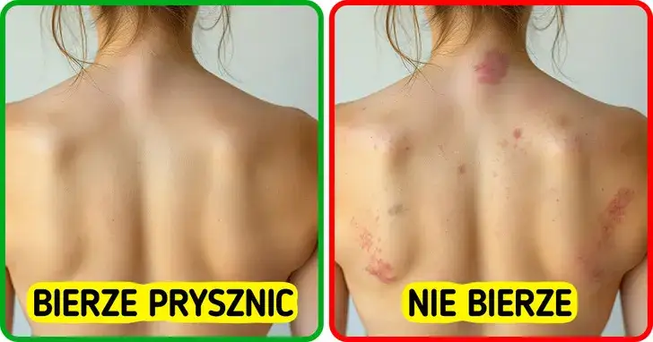 konsekwencje braku higieny sk&oacute;ry