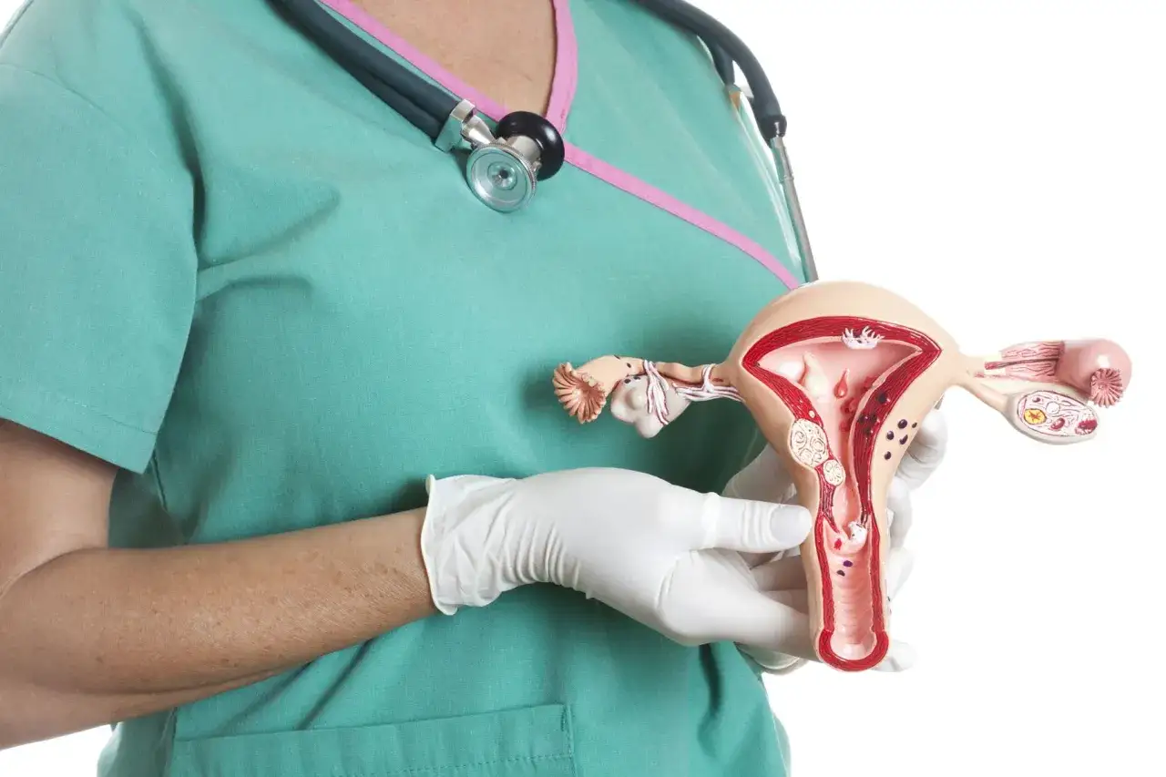 endometrioza torbiel jajnika mięśniak macicy grafika