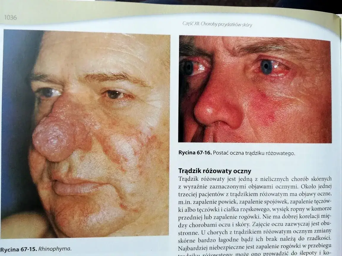 cera naczynkowa a trądzik różowaty porównanie
