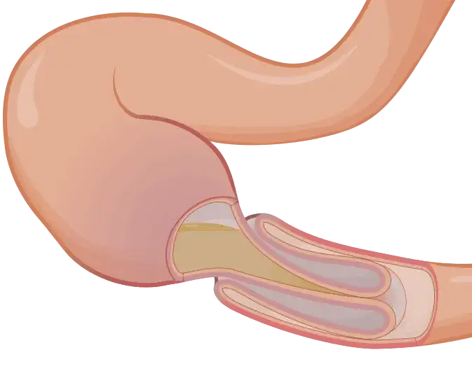 Zdjęcie Wgłobienie jelita u niemowlaka objawy, które mogą zaniepokoić rodziców