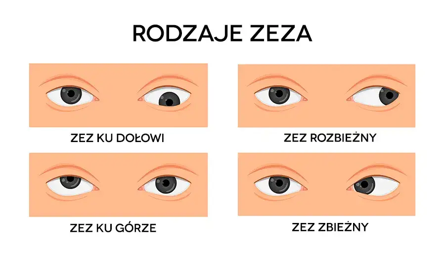 Zdjęcie Czy zez jest uleczalny? Poznaj skuteczne metody leczenia zeza