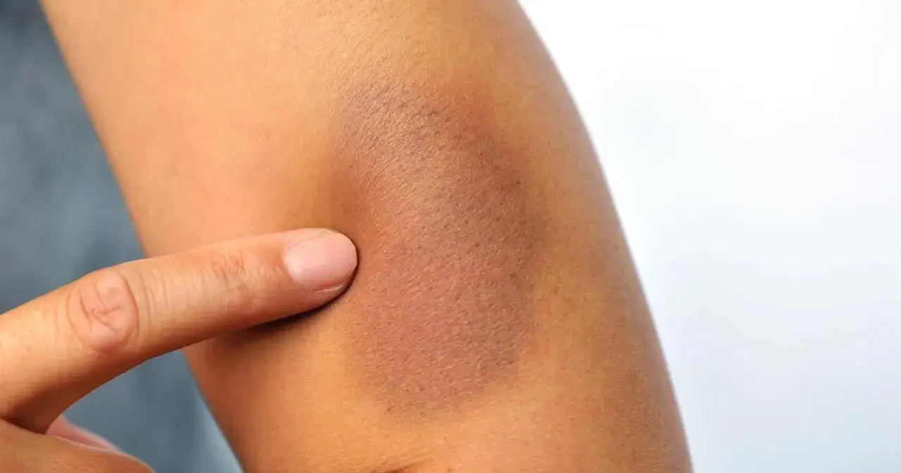 Zdjęcie Choroby serca objawy skórne – nie ignoruj tych niebezpiecznych symptomów