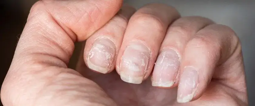 Zdjęcie Jak wyglądają rozdwajające się paznokcie i jak je rozpoznać?