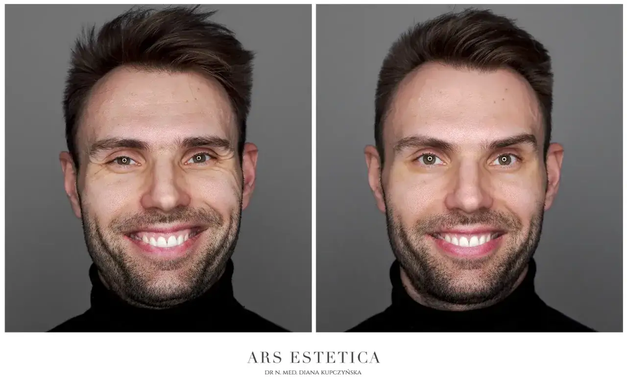 Przed i po zabiegu: wygładzone zmarszczki wok&oacute;ł oczu. Czy botox jest bezpieczny? Tak, przy odpowiednim zastosowaniu.