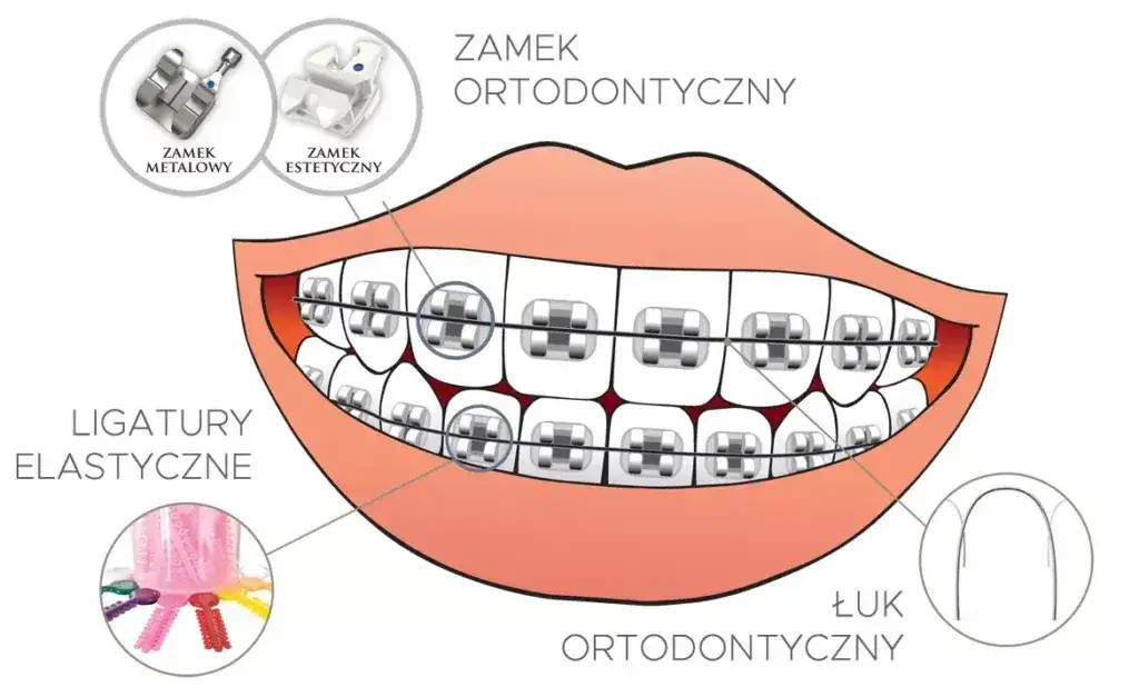 etapy przygotowania do aparatu ortodontycznego