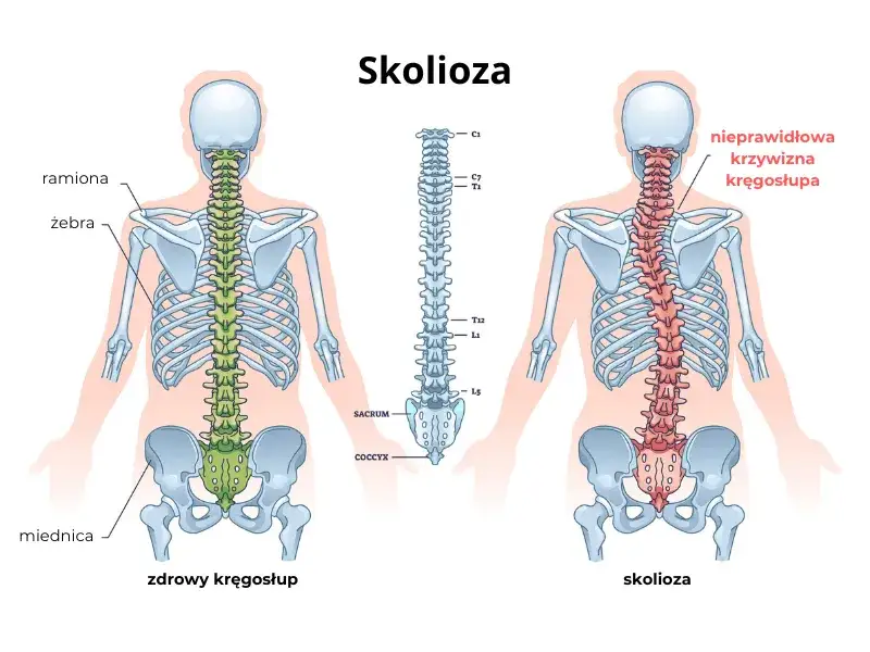 Rodzaje skoliozy kręgosłupa i kąt Cobba