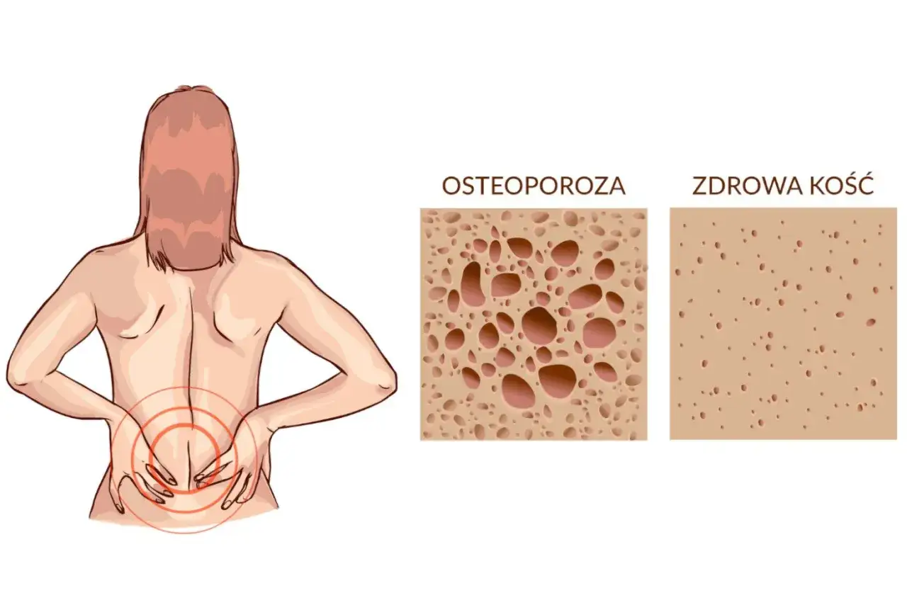 Ilustracja pokazuje ból pleców i porównuje strukturę kości przy osteoporozie (duże pory) ze zdrową kością (małe pory), co jest kluczowe w nowoczesnym leczeniu osteoporozy.