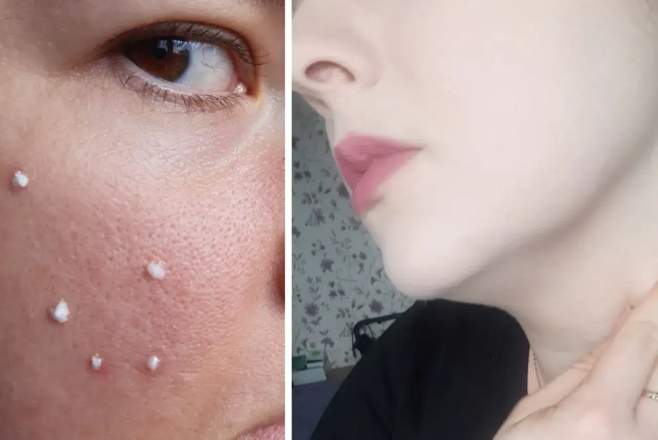 kobieta z problemami skórnymi przed i po