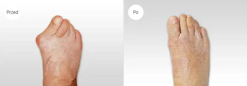haluksy przed i po operacji
