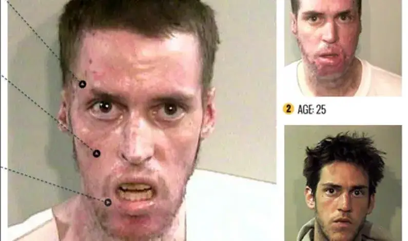 sk&oacute;ra po amfetaminie wygląd