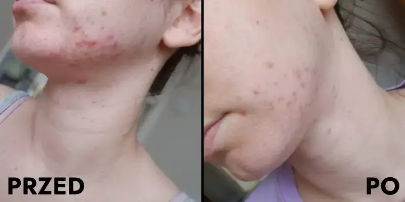 serum wygładzające efekty przed po