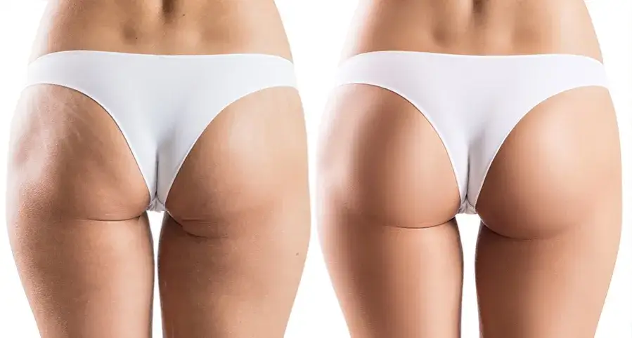 r&oacute;żne metody liposukcji por&oacute;wnanie