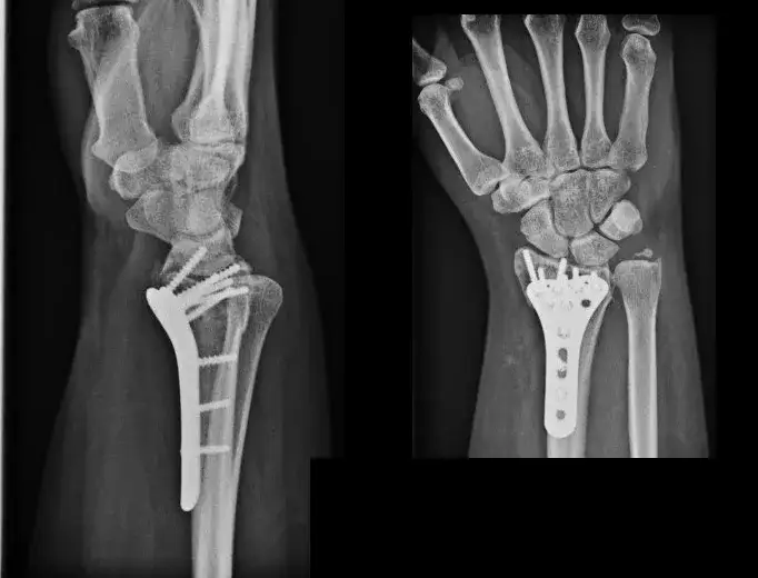 rentgen nadgarstka złamanie skręcenie