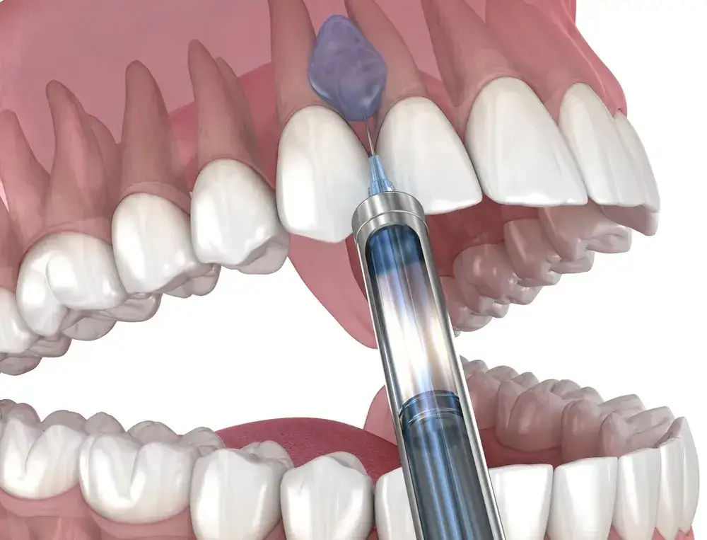 Rodzaje znieczulenia miejscowego u dentysty