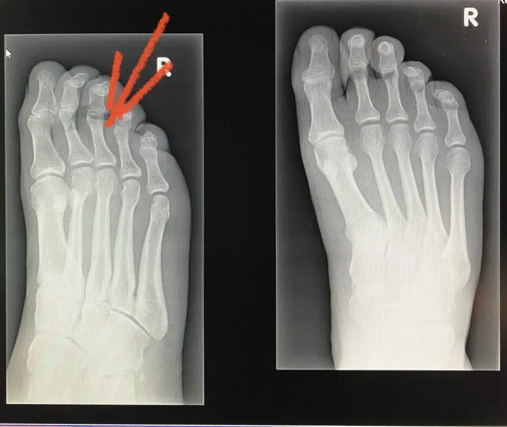 stłuczenie palca serdecznego vs złamanie rentgen