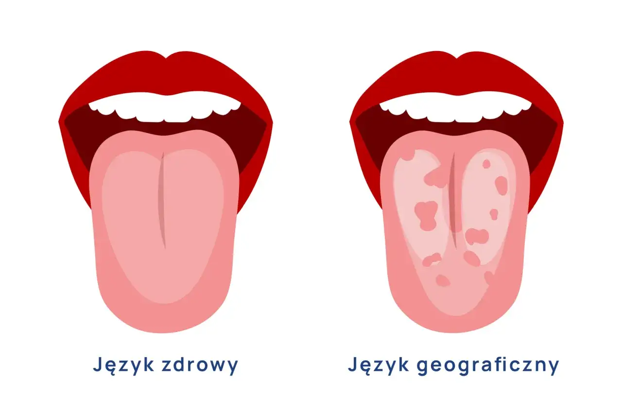 Dwa języki: zdrowy, r&oacute;żowy i język geograficzny z czerwonymi plamami.