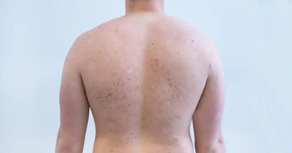 dermatolog konsultacja trądzik plecy