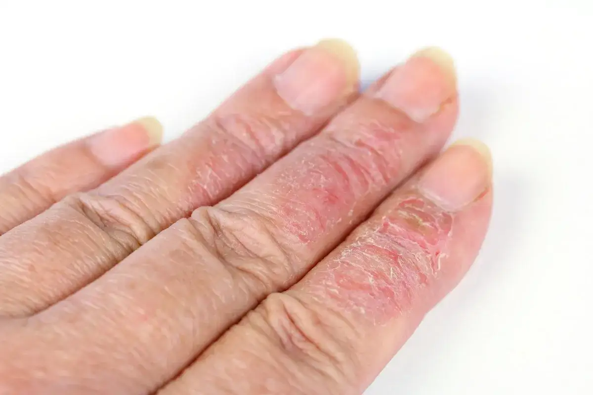 Skóra palców zaczerwieniona, łuszcząca się i pęknięta. Może to być uczulenie po manicure tytanowym.
