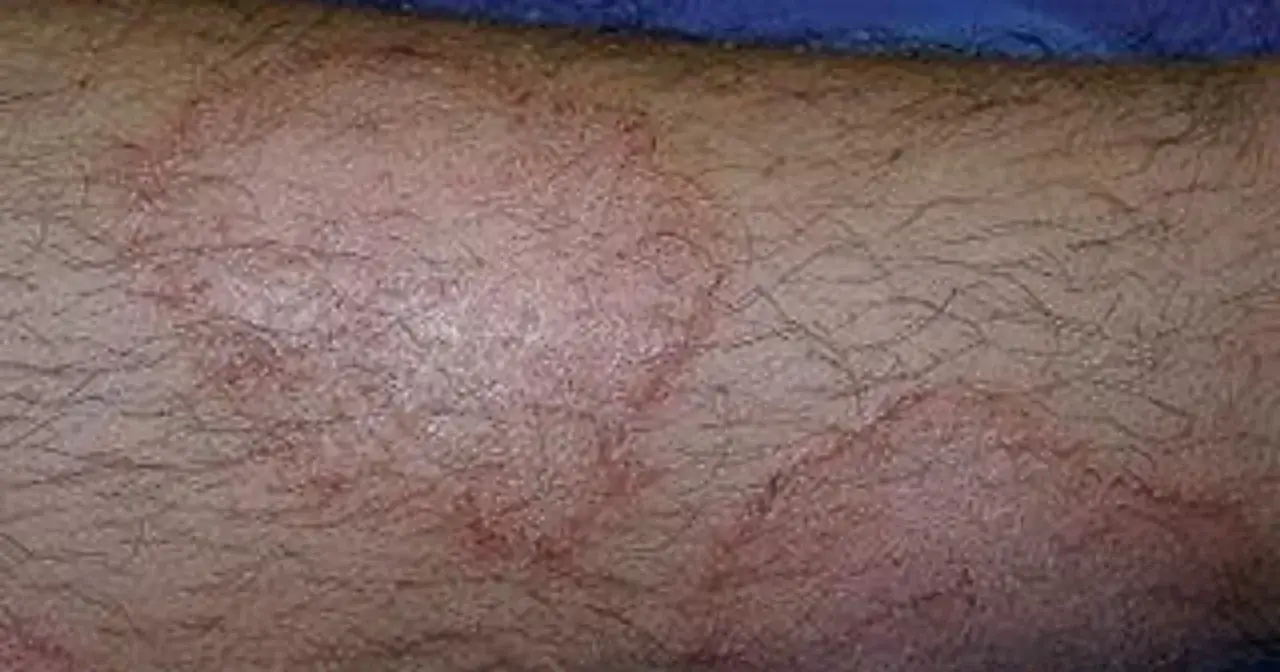 Wyprysk pieniążkowaty na skórze, widoczne okrągłe, zaczerwienione zmiany z łuskami.