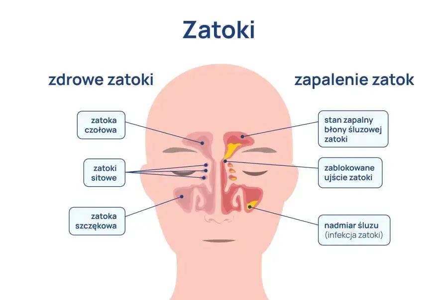Zdjęcie Jaki lekarz leczy zatoki? Kluczowe informacje, kt&oacute;re musisz znać
