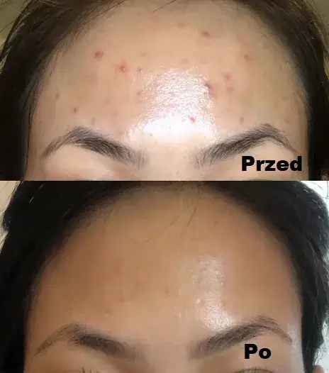 Zdjęcie Kwas glikolowy – dla jakiej cery jest najlepszy i jak uniknąć błędów w stosowaniu