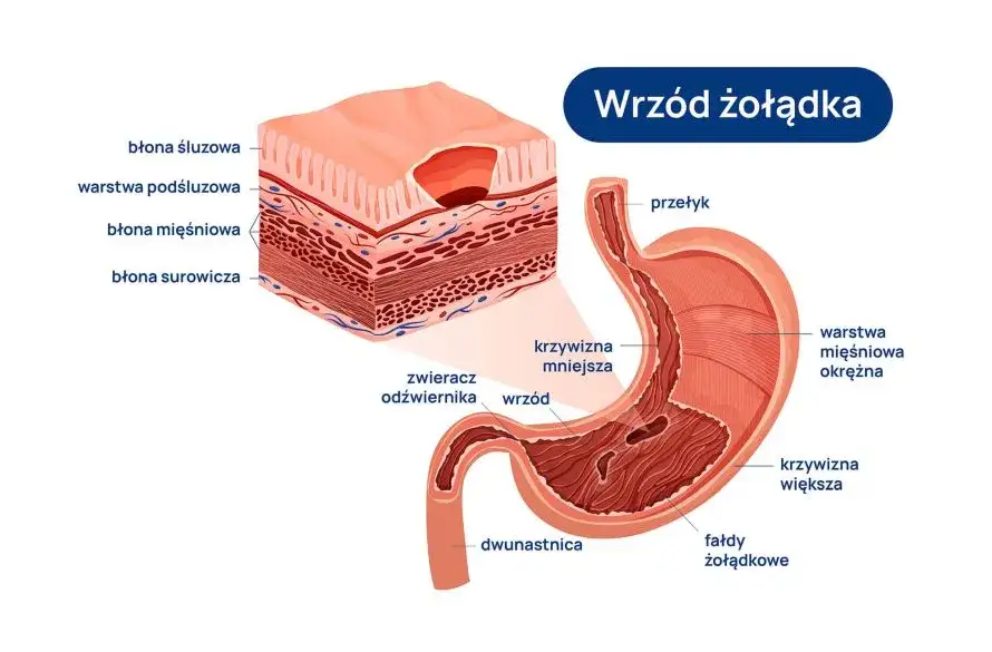 objawy wrzodów żołądka infografika