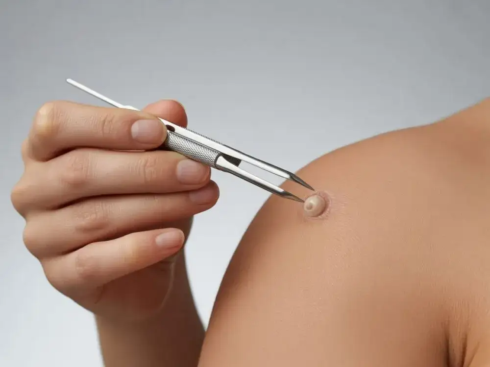 Przygotowanie skóry do zabiegu wyciskania pryszcza, higiena