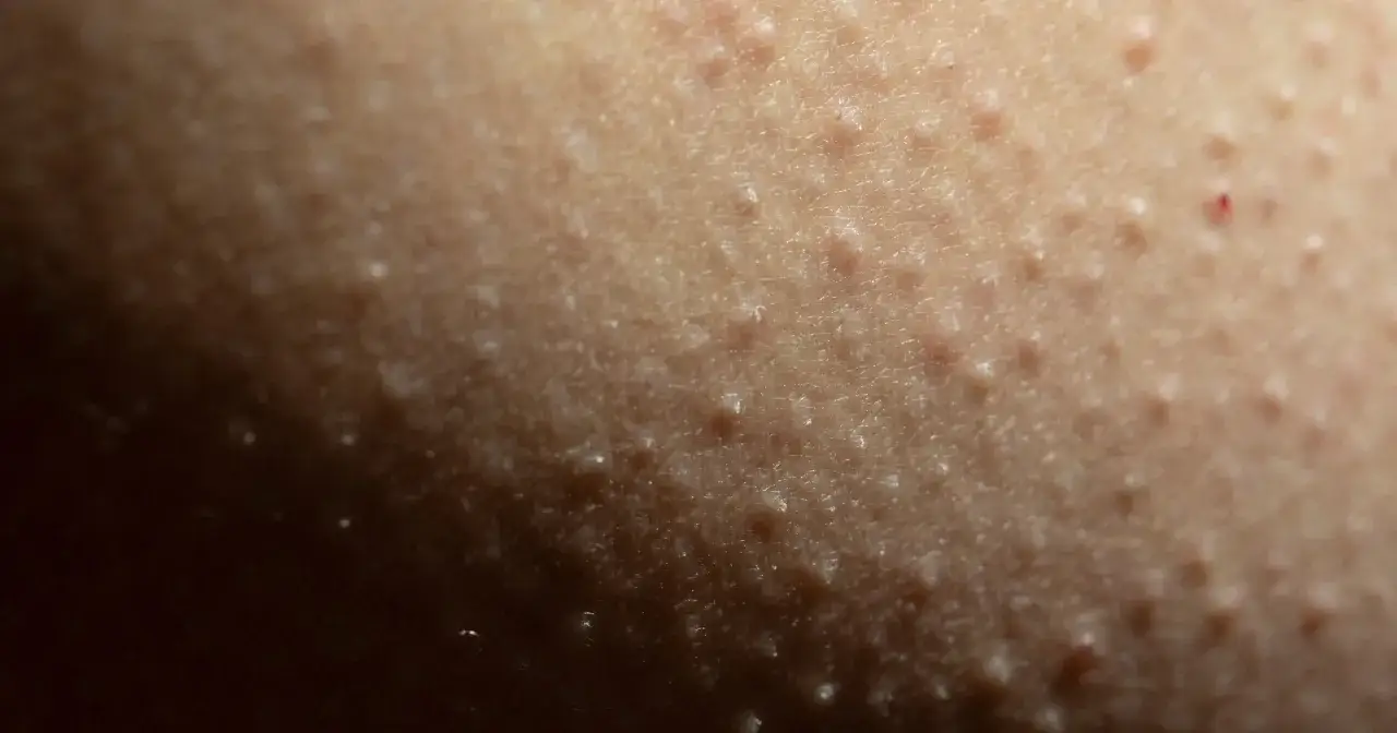 rogowacenie okołomieszkowe na udach