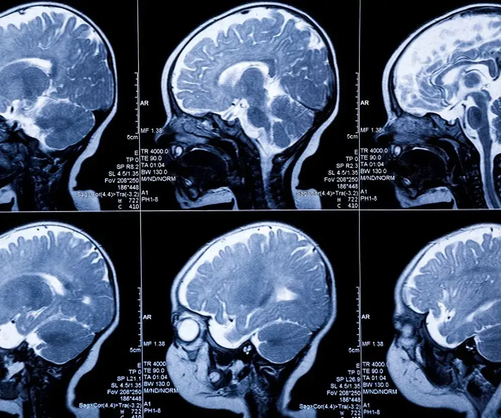 gruczolak przysadki objawy psychiczne infografika