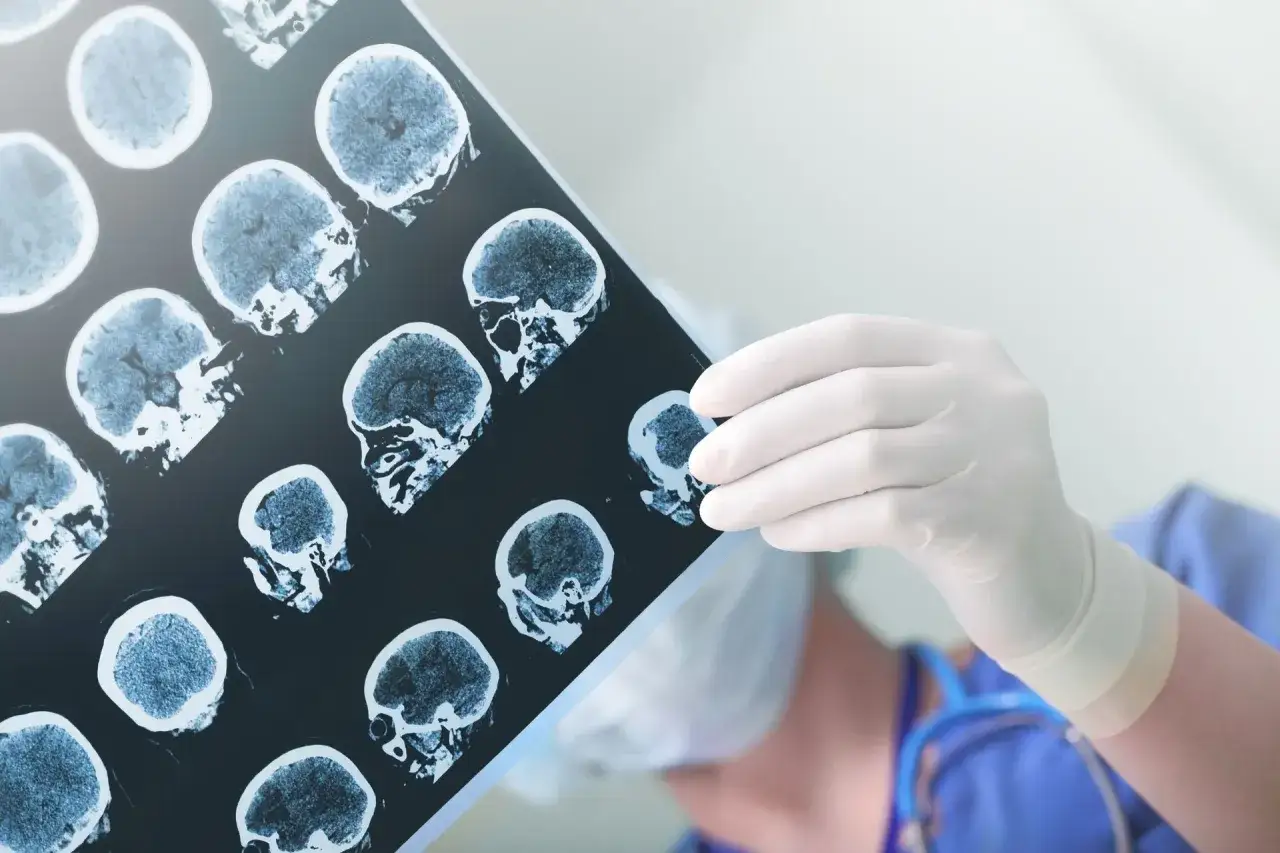 Lekarz w białej rękawiczce analizuje prześwietlenia m&oacute;zgu, szukając odpowiedzi na pytanie: ile się żyje po udarze m&oacute;żdżku.
