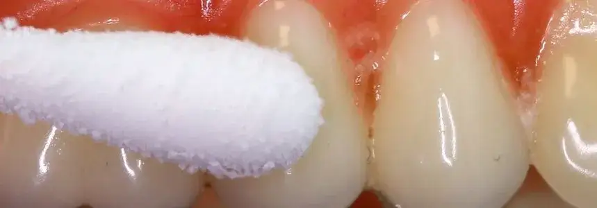 dentysta wykonuje test żywotności zęba na zimno