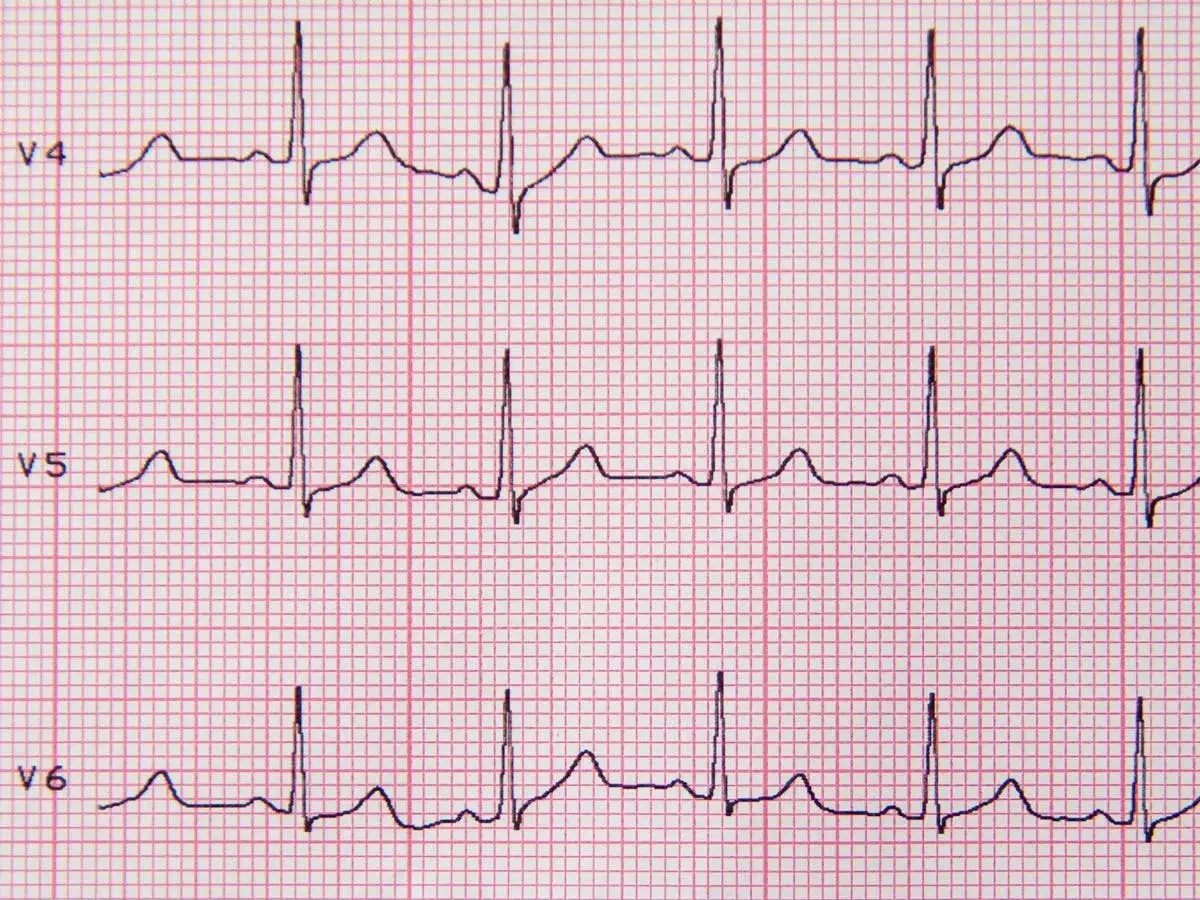 EKG z odprowadzeń V4, V5, V6. Analiza zapisu EKG, czyli co to jest HRV, może pomóc w ocenie pracy serca.