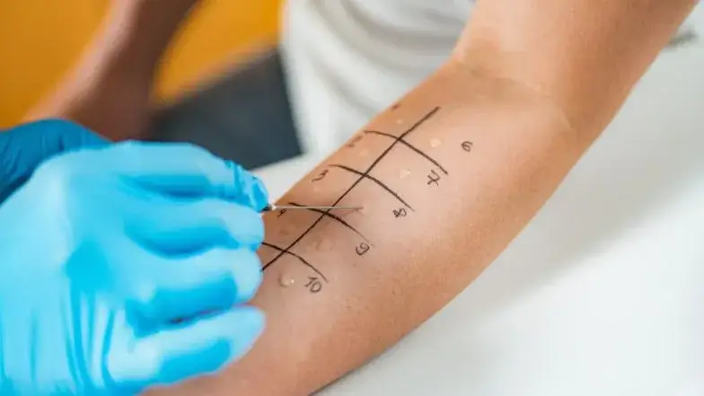 testy alergiczne sk&oacute;rne, badanie krwi alergia