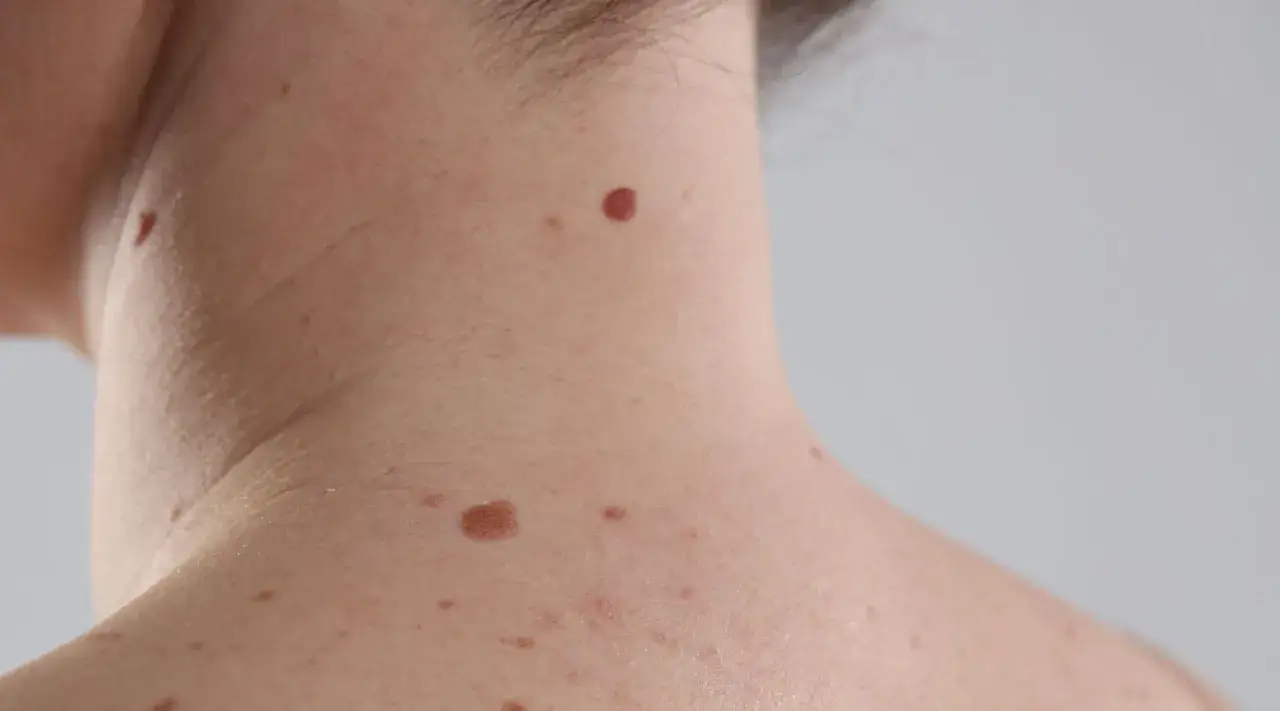 Widoczne na skórze szyi i ramienia liczne znamiona, w tym jedno wyraźne, ciemnobrązowe, okrągłe znamię.