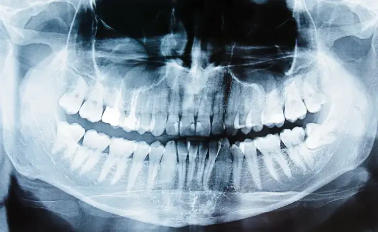 Zdjęcie Ile korzeni ma ząb 5 górna? Odkryj zaskakujące fakty o anatomii