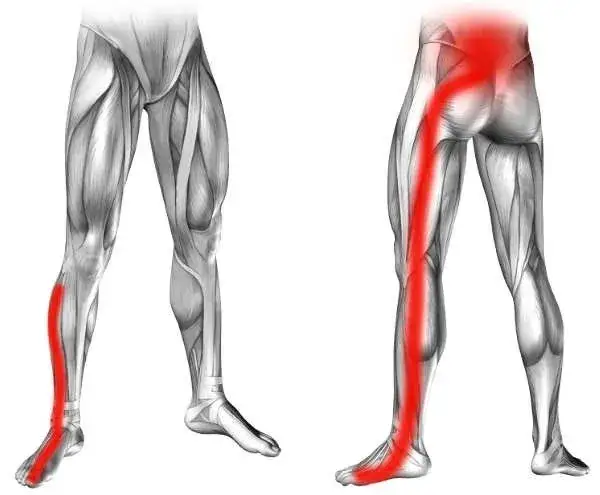 Mapa bólu korzonków promieniowanie nerwów rwa kulszowa barkowa udowa