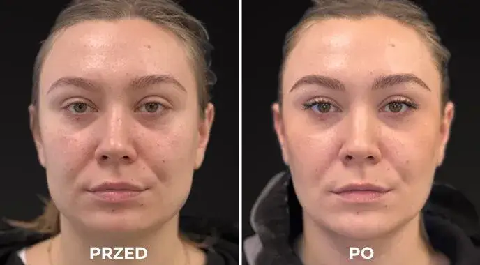 botox nieskuteczny rozczarowanie