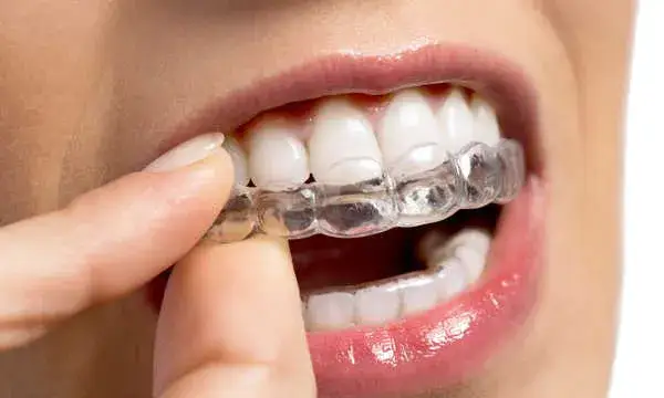 aparat nakładkowy invisalign