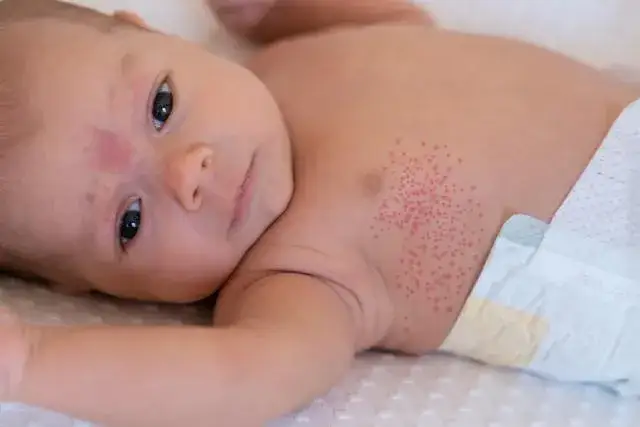 Zdjęcie Jak rozpoznać potówki u niemowlaka - objawy i skuteczne leczenie