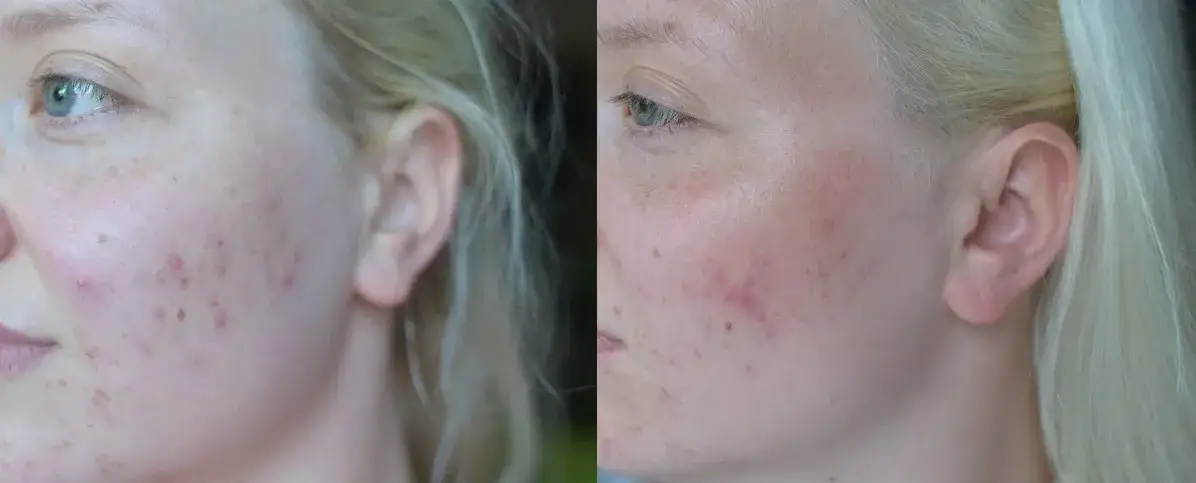 Prawidłowa aplikacja żelu punktowego na twarz