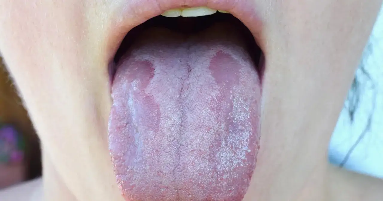 Język z nalotem i zaczerwienieniem, objawy grzybicy jamy ustnej.