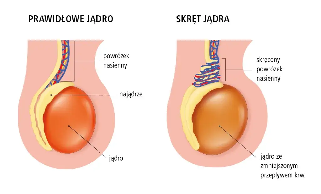 Skręt jądra schemat