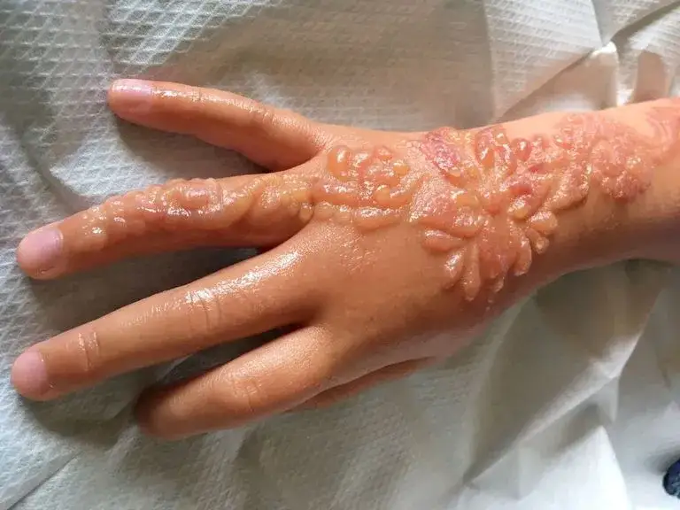 reakcja alergiczna po tatuażu czarną henną