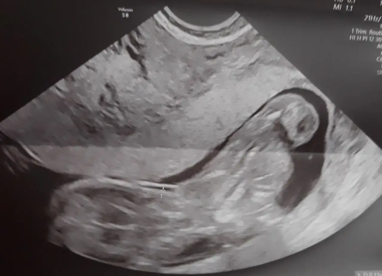 USG genetyczne 13 tydzień ciąży